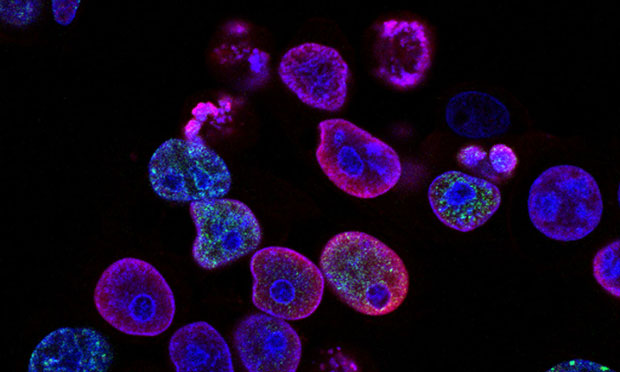 Colorectal cancer cells (cancer.gov)