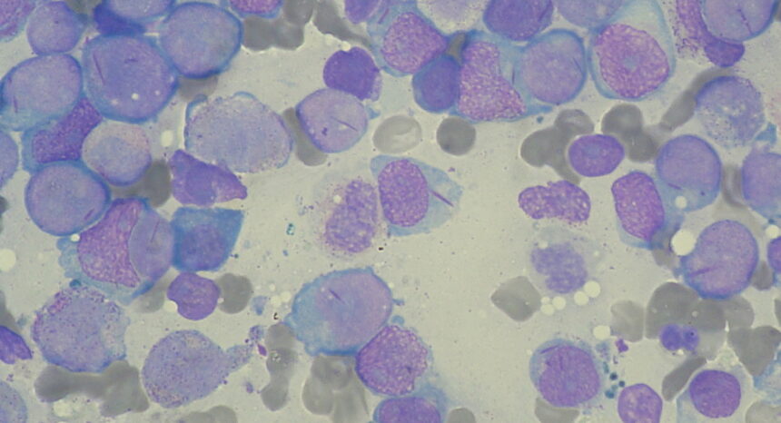 Blood smear showing acute myeloid leukemia